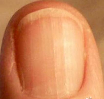 你的指甲上有一条条竖线吗
